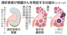 　透析患者が腎臓がんを発症する仕組み（イメージ）